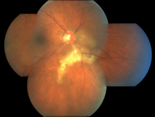 Serpiginouse Choroiditis (Chorioretinitis) - Acute Right Eye - Old Left Eye VA 20/25 OD , 20/50 OS
63-year-old woman has serpiginous choroiditis (date - March 2011).  The right eye has not been previously involved, and then she noticed new onset floaters in the right eye for the last two weeks.  Her vision in the right eye is hazy because of that.

VISUAL ACUITY:  Vision OD is 20/25, OS is 20/50
