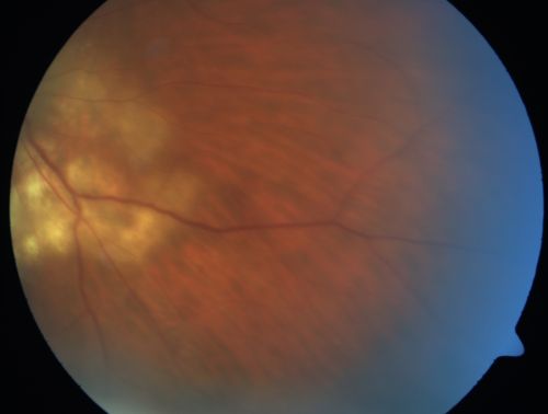 Serpiginouse Choroiditis (Chorioretinitis) - Acute Right Eye - Old Left Eye VA 20/25 OD , 20/50 OS
63-year-old woman has serpiginous choroiditis (date - March 2011).  The right eye has not been previously involved, and then she noticed new onset floaters in the right eye for the last two weeks.  Her vision in the right eye is hazy because of that.

VISUAL ACUITY:  Vision OD is 20/25, OS is 20/50
