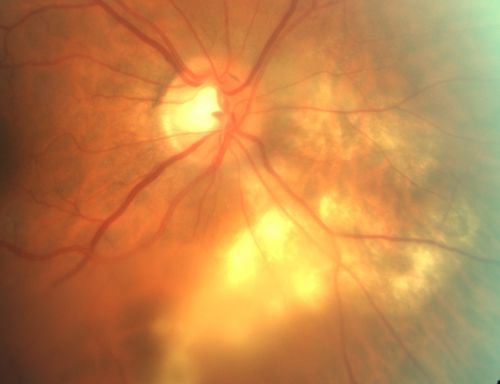 Serpiginouse Choroiditis (Chorioretinitis) - Acute Right Eye - Old Left Eye VA 20/25 OD , 20/50 OS - 1 Week After Intravitreal Kenalog OD
63-year-old woman has serpiginous choroiditis  1 week after intravitreal kenalog treatment
