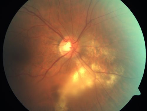 Serpiginouse Choroiditis (Chorioretinitis) - Acute Right Eye - Old Left Eye VA 20/25 OD , 20/50 OS - 1 Week After Intravitreal Kenalog OD
63-year-old woman has serpiginous choroiditis  1 week after intravitreal kenalog treatment
