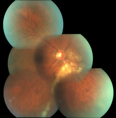 Serpiginouse Choroiditis (Chorioretinitis) - Acute Right Eye - Old Left Eye VA 20/25 OD , 20/50 OS - 1 Week After Intravitreal Kenalog OD
63-year-old woman has serpiginous choroiditis  1 week after intravitreal kenalog treatment
