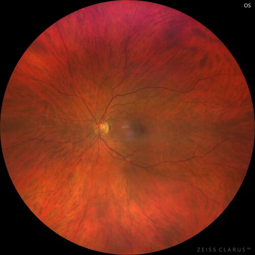 Serpiginous choroiditis in the right eye
68 year old female with spots in vision in the right eye for 2 months.  She has a history of MS.  The vision is 20/32 in both eyes.  She was treated with high dose steroids and transitioned to methotrexate and the right eye quieted  down.
