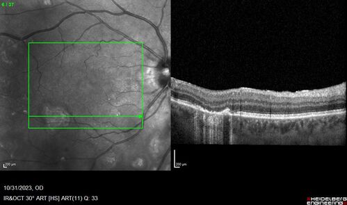 Serpiginous choroiditis in the right eye
68 year old female with spots in vision in the right eye for 2 months.  She has a history of MS.  The vision is 20/32 in both eyes.  She was treated with high dose steroids and transitioned to methotrexate and the right eye quieted  down.
