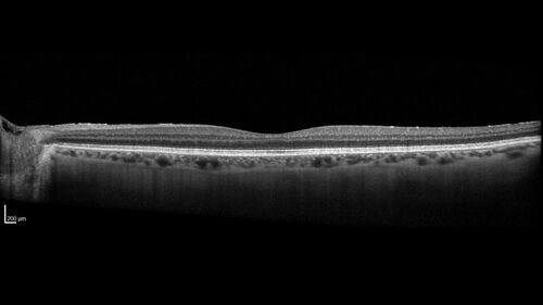 Serpiginous choroiditis in the right eye
68 year old female with spots in vision in the right eye for 2 months.  She has a history of MS.  The vision is 20/32 in both eyes.  She was treated with high dose steroids and transitioned to methotrexate and the right eye quieted  down.

