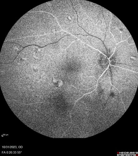 Serpiginous choroiditis in the right eye
68 year old female with spots in vision in the right eye for 2 months.  She has a history of MS.  The vision is 20/32 in both eyes.  She was treated with high dose steroids and transitioned to methotrexate and the right eye quieted  down.
