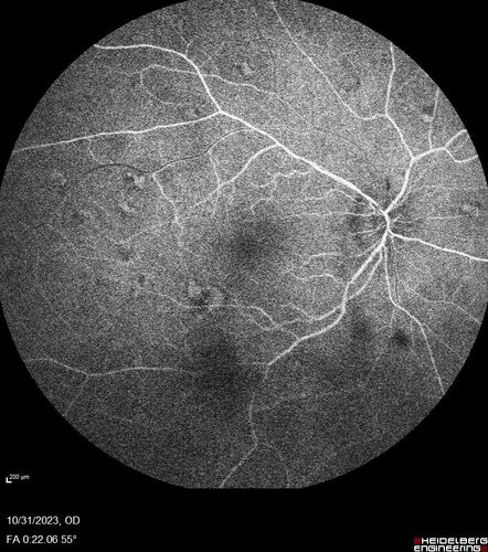 Serpiginous choroiditis in the right eye
68 year old female with spots in vision in the right eye for 2 months.  She has a history of MS.  The vision is 20/32 in both eyes.  She was treated with high dose steroids and transitioned to methotrexate and the right eye quieted  down.
