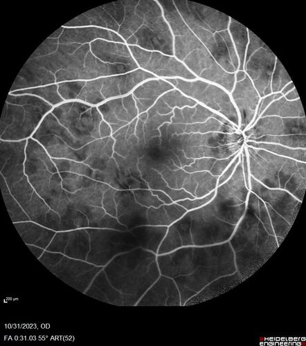 Serpiginous choroiditis in the right eye
68 year old female with spots in vision in the right eye for 2 months.  She has a history of MS.  The vision is 20/32 in both eyes.  She was treated with high dose steroids and transitioned to methotrexate and the right eye quieted  down.
