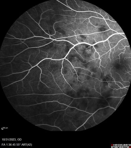 Serpiginous choroiditis in the right eye
68 year old female with spots in vision in the right eye for 2 months.  She has a history of MS.  The vision is 20/32 in both eyes.  She was treated with high dose steroids and transitioned to methotrexate and the right eye quieted  down.
