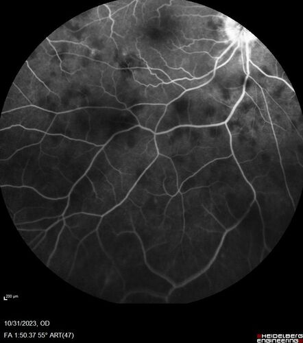 Serpiginous choroiditis in the right eye
68 year old female with spots in vision in the right eye for 2 months.  She has a history of MS.  The vision is 20/32 in both eyes.  She was treated with high dose steroids and transitioned to methotrexate and the right eye quieted  down.
