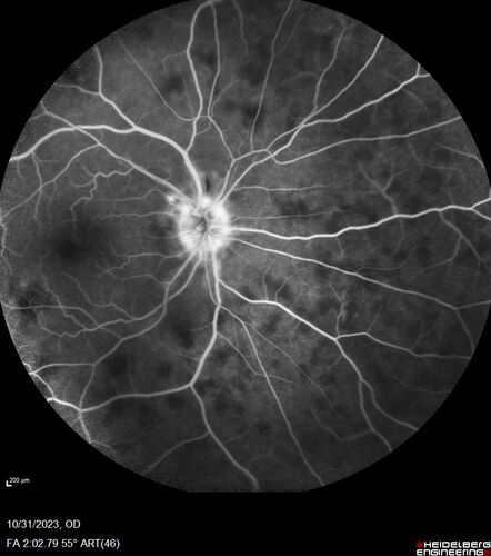 Serpiginous choroiditis in the right eye
68 year old female with spots in vision in the right eye for 2 months.  She has a history of MS.  The vision is 20/32 in both eyes.  She was treated with high dose steroids and transitioned to methotrexate and the right eye quieted  down.
