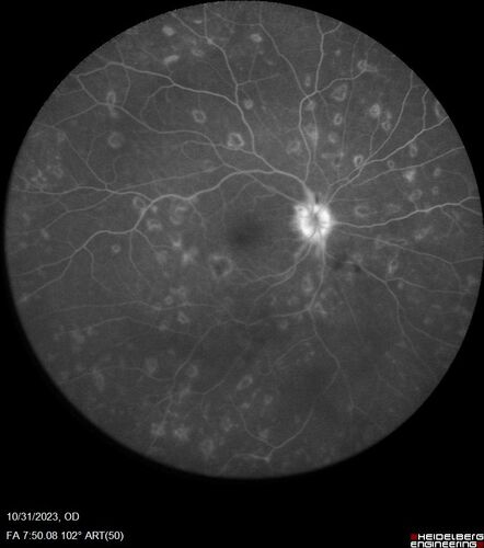 Serpiginous choroiditis in the right eye
68 year old female with spots in vision in the right eye for 2 months.  She has a history of MS.  The vision is 20/32 in both eyes.  She was treated with high dose steroids and transitioned to methotrexate and the right eye quieted  down.
