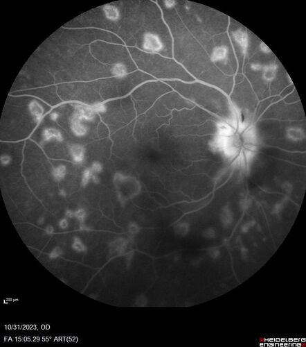 Serpiginous choroiditis in the right eye
68 year old female with spots in vision in the right eye for 2 months.  She has a history of MS.  The vision is 20/32 in both eyes.  She was treated with high dose steroids and transitioned to methotrexate and the right eye quieted  down.
