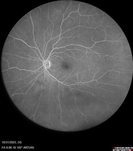Serpiginous choroiditis in the right eye
68 year old female with spots in vision in the right eye for 2 months.  She has a history of MS.  The vision is 20/32 in both eyes.  She was treated with high dose steroids and transitioned to methotrexate and the right eye quieted  down.
