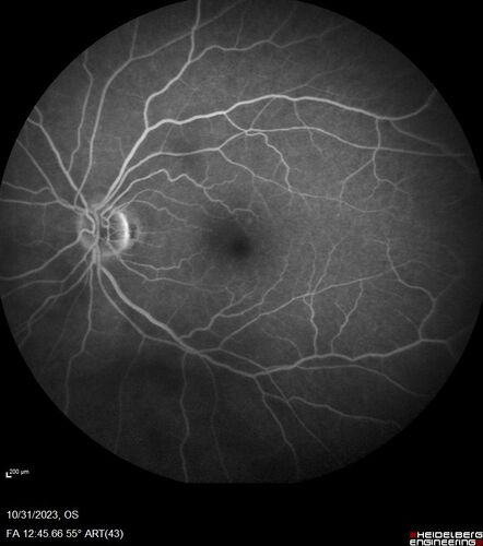 Serpiginous choroiditis in the right eye
68 year old female with spots in vision in the right eye for 2 months.  She has a history of MS.  The vision is 20/32 in both eyes.  She was treated with high dose steroids and transitioned to methotrexate and the right eye quieted  down.

