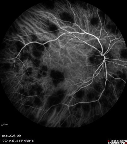 Serpiginous choroiditis in the right eye
68 year old female with spots in vision in the right eye for 2 months.  She has a history of MS.  The vision is 20/32 in both eyes.  She was treated with high dose steroids and transitioned to methotrexate and the right eye quieted  down.
