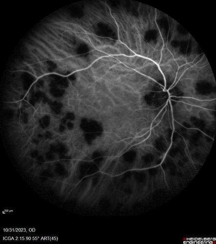Serpiginous choroiditis in the right eye
68 year old female with spots in vision in the right eye for 2 months.  She has a history of MS.  The vision is 20/32 in both eyes.  She was treated with high dose steroids and transitioned to methotrexate and the right eye quieted  down.
