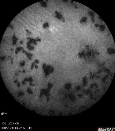 Serpiginous choroiditis in the right eye
68 year old female with spots in vision in the right eye for 2 months.  She has a history of MS.  The vision is 20/32 in both eyes.  She was treated with high dose steroids and transitioned to methotrexate and the right eye quieted  down.
