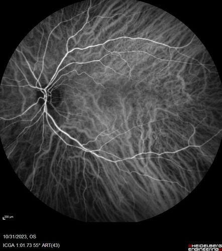 Serpiginous choroiditis in the right eye
68 year old female with spots in vision in the right eye for 2 months.  She has a history of MS.  The vision is 20/32 in both eyes.  She was treated with high dose steroids and transitioned to methotrexate and the right eye quieted  down.
