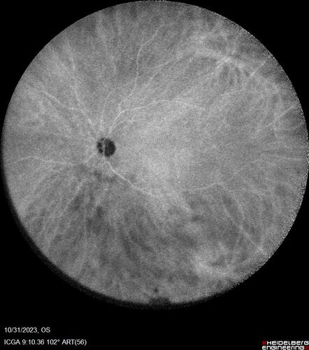 Serpiginous choroiditis in the right eye
68 year old female with spots in vision in the right eye for 2 months.  She has a history of MS.  The vision is 20/32 in both eyes.  She was treated with high dose steroids and transitioned to methotrexate and the right eye quieted  down.
