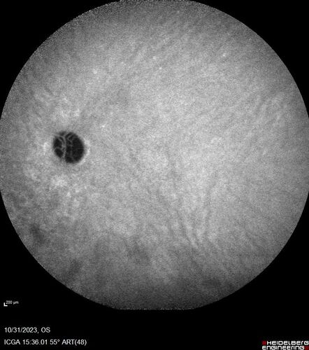 Serpiginous choroiditis in the right eye
68 year old female with spots in vision in the right eye for 2 months.  She has a history of MS.  The vision is 20/32 in both eyes.  She was treated with high dose steroids and transitioned to methotrexate and the right eye quieted  down.
