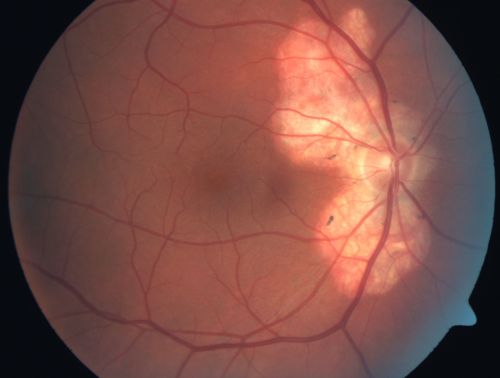 Serpiginous choroiditis
Inactive scars in both eyes
