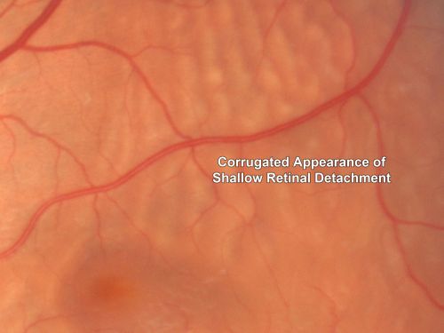 Recurrent Macula Off Retinal Detachment - Corrugated Shallow Appearance
