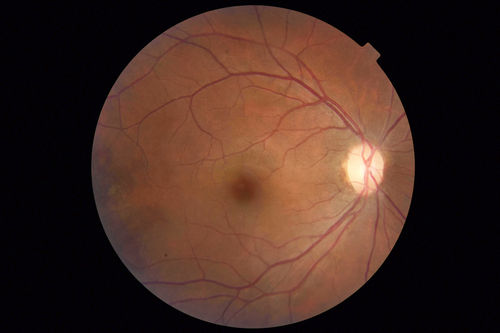 Sickle Retinopathy - Chronic retinal detachment OS - Proliferation OD
40 year old with known SC disease.  Failed to return 4 years ago for treatment and lost ision in the left eye.  Then returned for one visit and refused further treatment.
