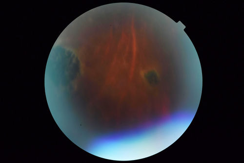 Sickle Retinopathy - Chronic retinal detachment OS - Proliferation OD
40 year old with known SC disease.  Failed to return 4 years ago for treatment and lost ision in the left eye.  Then returned for one visit and refused further treatment.
