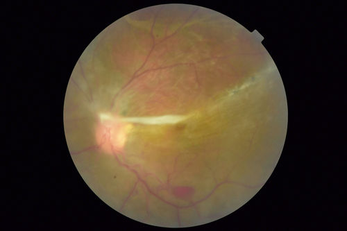 Sickle Retinopathy - Chronic retinal detachment OS - Proliferation OD
40 year old with known SC disease.  Failed to return 4 years ago for treatment and lost ision in the left eye.  Then returned for one visit and refused further treatment.
