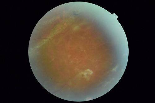 Sickle Retinopathy - Chronic retinal detachment OS - Proliferation OD
40 year old with known SC disease.  Failed to return 4 years ago for treatment and lost ision in the left eye.  Then returned for one visit and refused further treatment.
