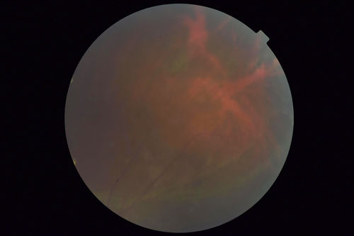 Sickle Retinopathy - Chronic retinal detachment OS - Proliferation OD
40 year old with known SC disease.  Failed to return 4 years ago for treatment and lost ision in the left eye.  Then returned for one visit and refused further treatment.
