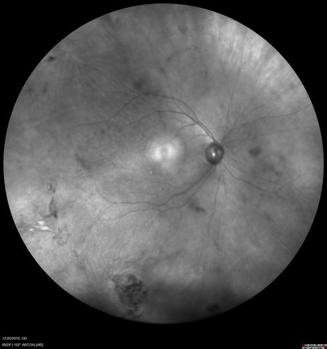 Sickle Retinopathy - Chronic retinal detachment OS - Proliferation OD
40 year old with known SC disease.  Failed to return 4 years ago for treatment and lost ision in the left eye.  Then returned for one visit and refused further treatment.
