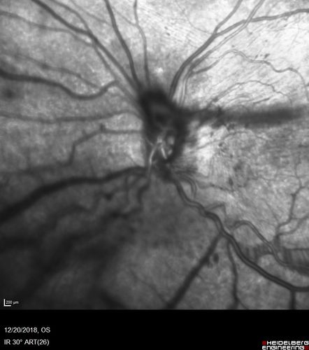 Sickle Retinopathy - Chronic retinal detachment OS - Proliferation OD
40 year old with known SC disease.  Failed to return 4 years ago for treatment and lost ision in the left eye.  Then returned for one visit and refused further treatment.
