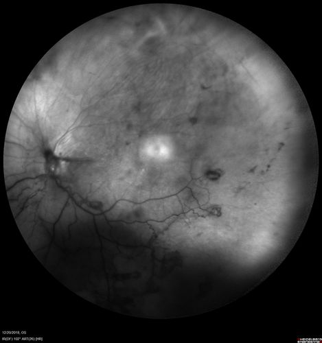 Sickle Retinopathy - Chronic retinal detachment OS - Proliferation OD
40 year old with known SC disease.  Failed to return 4 years ago for treatment and lost ision in the left eye.  Then returned for one visit and refused further treatment.
