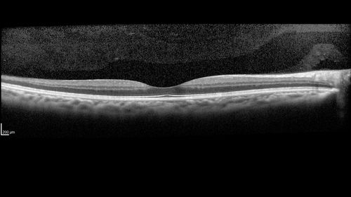 Sickle Retinopathy - Chronic retinal detachment OS - Proliferation OD
40 year old with known SC disease.  Failed to return 4 years ago for treatment and lost ision in the left eye.  Then returned for one visit and refused further treatment.
