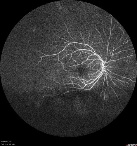 Sickle Retinopathy - Chronic retinal detachment OS - Proliferation OD
40 year old with known SC disease.  Failed to return 4 years ago for treatment and lost ision in the left eye.  Then returned for one visit and refused further treatment.
