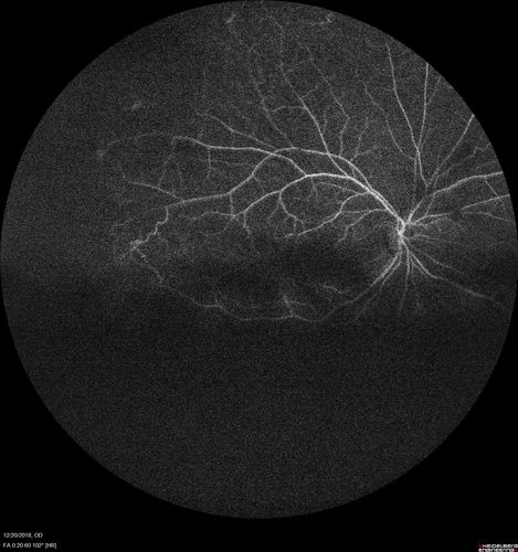 Sickle Retinopathy - Chronic retinal detachment OS - Proliferation OD
40 year old with known SC disease.  Failed to return 4 years ago for treatment and lost ision in the left eye.  Then returned for one visit and refused further treatment.
