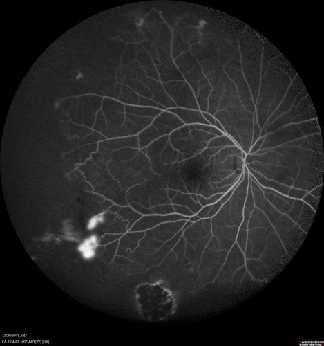 Sickle Retinopathy - Chronic retinal detachment OS - Proliferation OD
40 year old with known SC disease.  Failed to return 4 years ago for treatment and lost ision in the left eye.  Then returned for one visit and refused further treatment.
