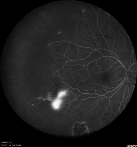 Sickle Retinopathy - Chronic retinal detachment OS - Proliferation OD
40 year old with known SC disease.  Failed to return 4 years ago for treatment and lost ision in the left eye.  Then returned for one visit and refused further treatment.
