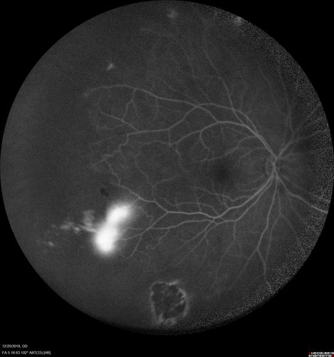 Sickle Retinopathy - Chronic retinal detachment OS - Proliferation OD
40 year old with known SC disease.  Failed to return 4 years ago for treatment and lost ision in the left eye.  Then returned for one visit and refused further treatment.
