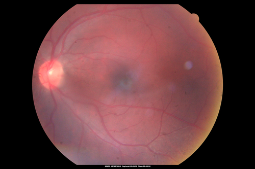 Sickle Retinpoathy SC Disease - Vitreous Hemorrhage Left Eye - 29 Year old
