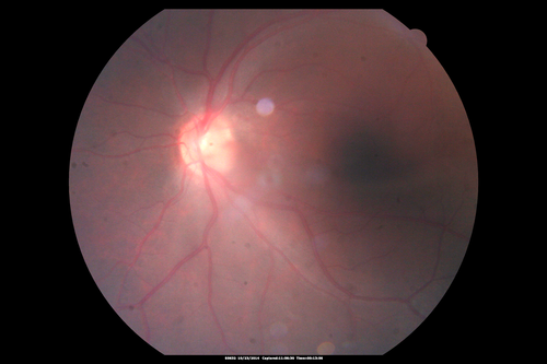 Sickle Retinpoathy SC Disease - Vitreous Hemorrhage Left Eye - 29 Year old
