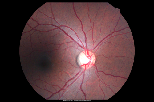 Sickle Retinpoathy SC Disease - Vitreous Hemorrhage Left Eye - 29 Year old
