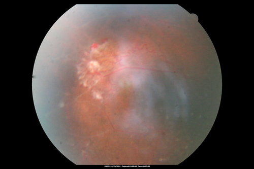 Sickle Retinpoathy SC Disease - Vitreous Hemorrhage Left Eye - 29 Year old
