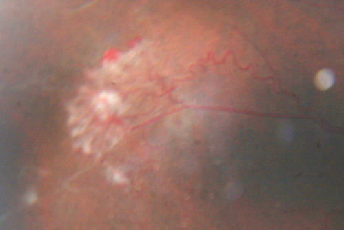 Sickle Retinpoathy SC Disease - Vitreous Hemorrhage Left Eye - 29 Year old
Frond of NV in the periphery
