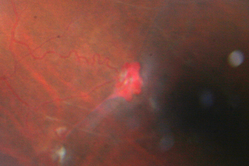 Sickle Retinpoathy SC Disease - Vitreous Hemorrhage Left Eye - 29 Year old
Frond of NV in the periphery
