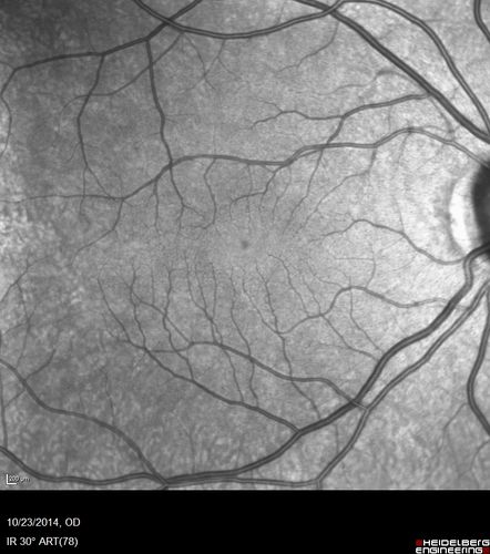 Sickle Retinpoathy SC Disease - Vitreous Hemorrhage Left Eye - 29 Year old
