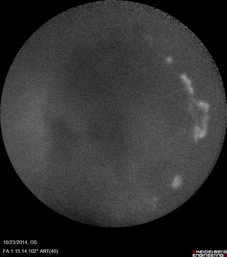 Sickle Retinopathy - Ultra Wide Field Angiogram - Heidelberg
Leakage from peripheral fronds of NV - HGB SC disease - 28 year old man with vision loss OS from acute vitreous hemorrhage
