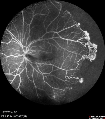 Sickle Retinopathy - Ultra Wide Field Angiogram - Heidelberg
Leakage from peripheral fronds of NV - HGB SC disease - 28 year old man with vision loss OS from acute vitreous hemorrhage
