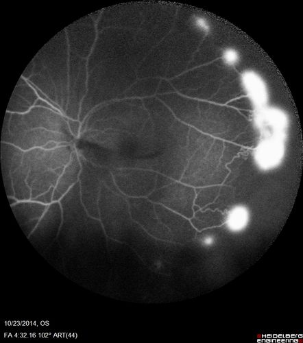 Sickle Retinopathy - Ultra Wide Field Angiogram - Heidelberg
Leakage from peripheral fronds of NV - HGB SC disease - 28 year old man with vision loss OS from acute vitreous hemorrhage
